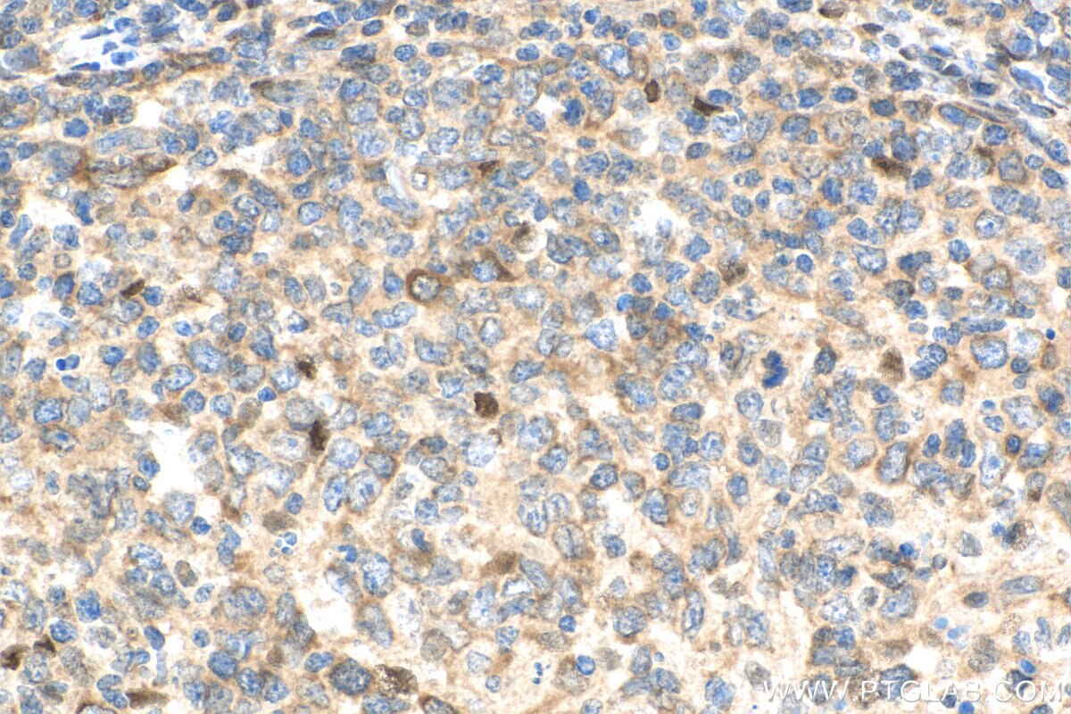 IHC staining of human lymphoma using 25027-1-AP