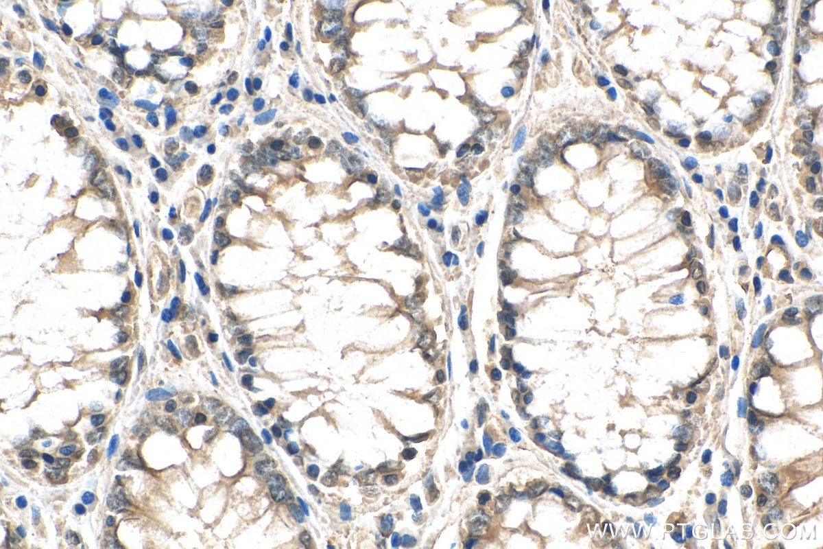 Immunohistochemistry (IHC) staining of human colon cancer tissue using RELB Polyclonal antibody (25027-1-AP)