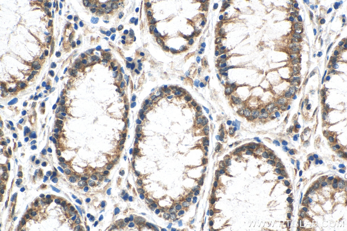 Immunohistochemistry (IHC) staining of human colon cancer tissue using RELB Polyclonal antibody (25027-1-AP)