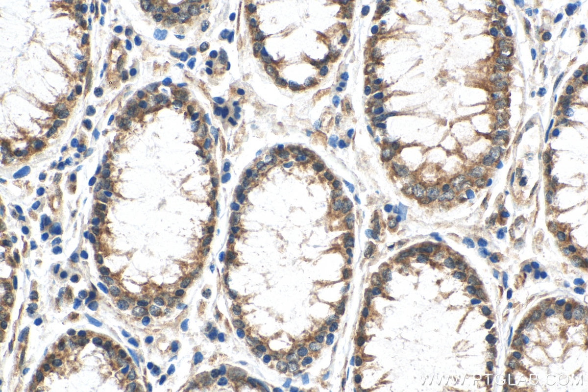 IHC staining of human colon cancer using 25027-1-AP