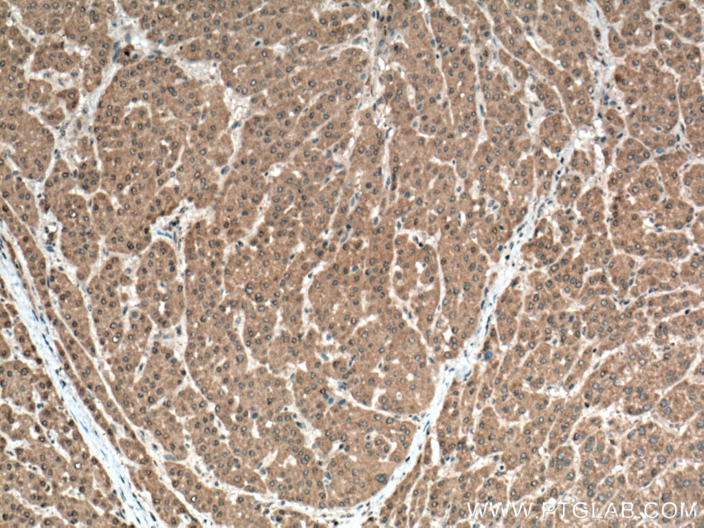 Immunohistochemistry (IHC) staining of human liver cancer tissue using RELN Polyclonal antibody (20689-1-AP)