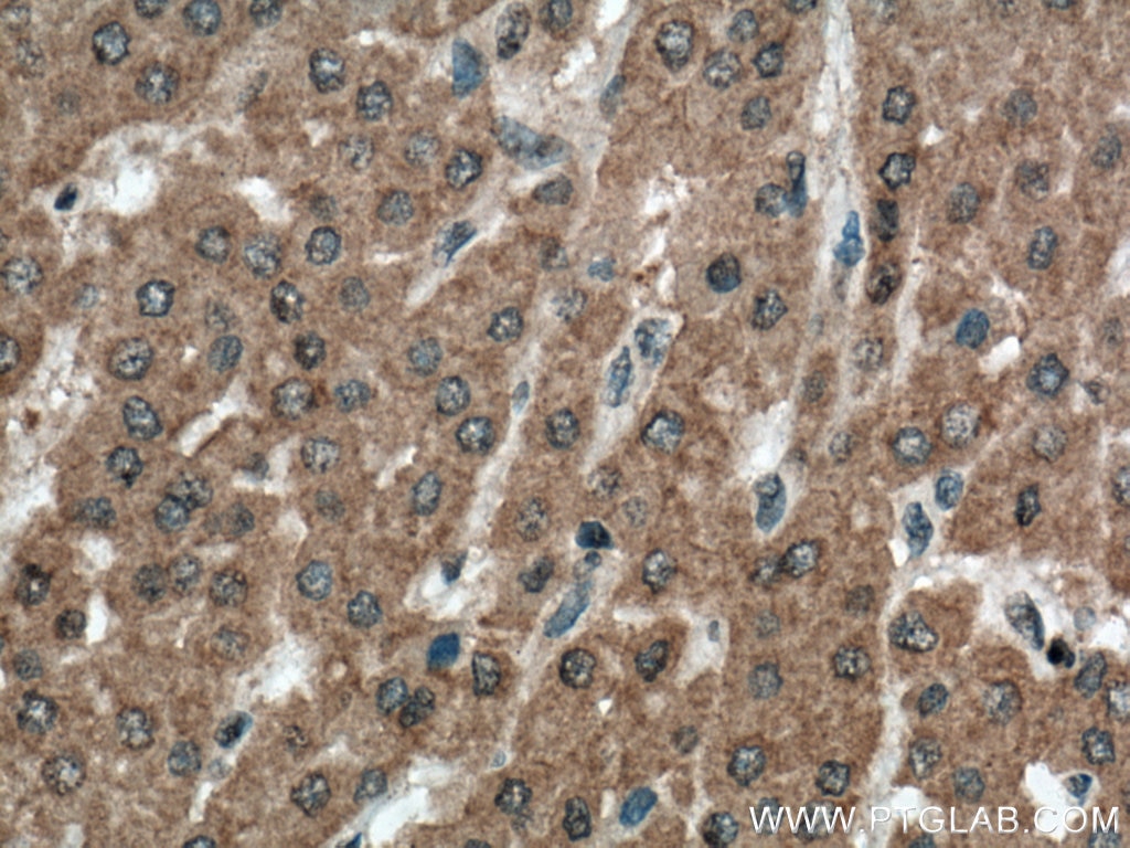 Immunohistochemistry (IHC) staining of human liver cancer tissue using RELN Polyclonal antibody (20689-1-AP)