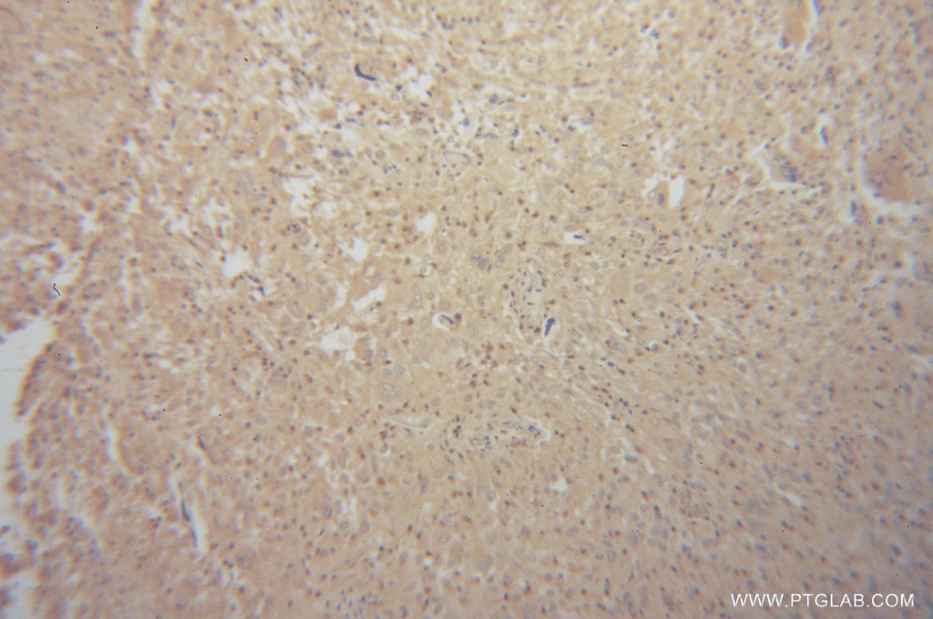 IHC staining of human gliomas using 14291-1-AP