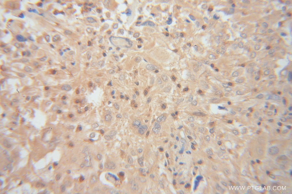 IHC staining of human gliomas using 14291-1-AP