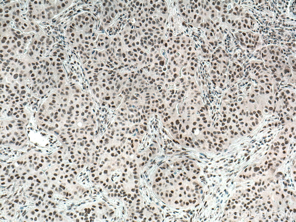 Immunohistochemistry (IHC) staining of human breast cancer tissue using REST Polyclonal antibody (22242-1-AP)