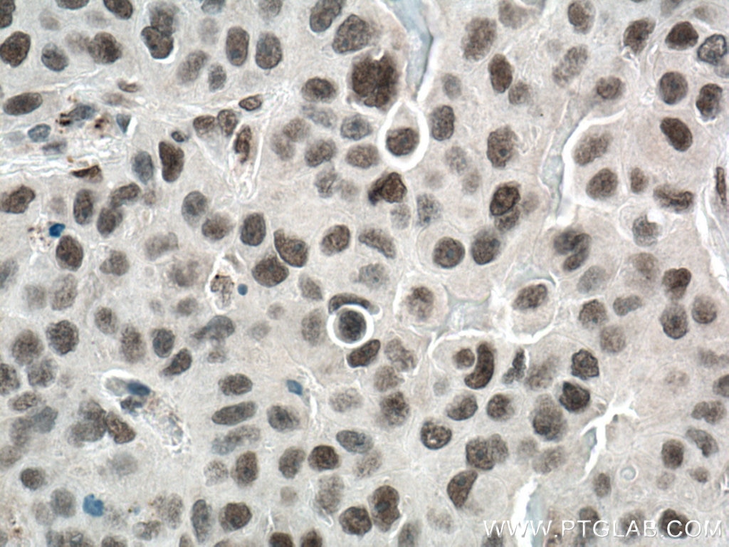 Immunohistochemistry (IHC) staining of human breast cancer tissue using REST Polyclonal antibody (22242-1-AP)