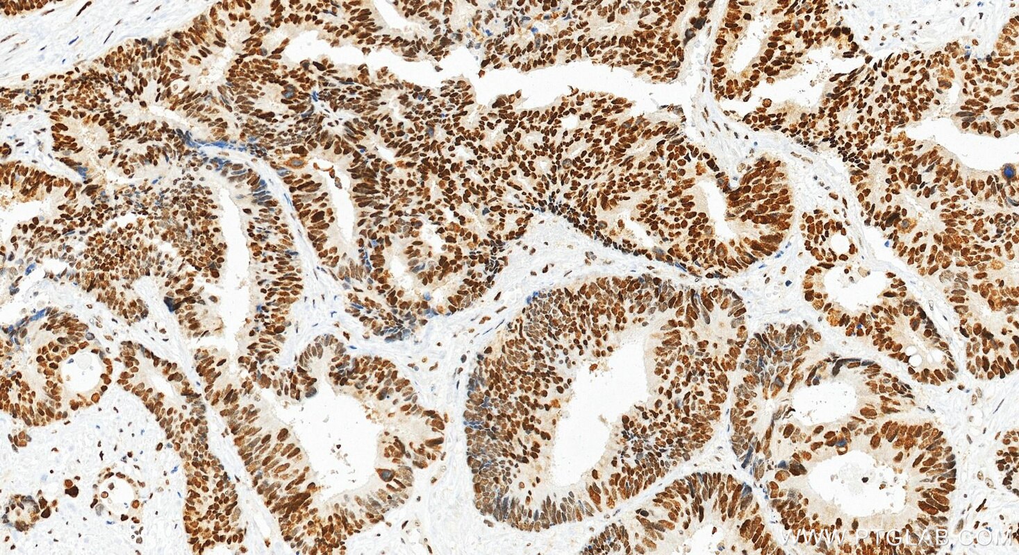 Immunohistochemical analysis of paraffin-embedded human colon cancer tissue slide using 84892-1-RR (RFC2 antibody) at dilution of 1:1000 (under 20x lens). Heat mediated antigen retrieval with Tris-EDTA buffer (pH 9.0). This data was developed using the same antibody clone with 84892-1-PBS in a different storage buffer formulation. Immunohistochemistry (IHC) staining of human colon cancer tissue using RFC2 Recombinant monoclonal antibody (84892-1-RR)