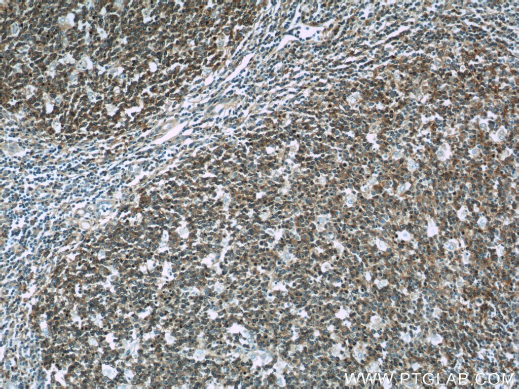 Immunohistochemistry (IHC) staining of human tonsillitis tissue using RFTN1 Polyclonal antibody (24289-1-AP)