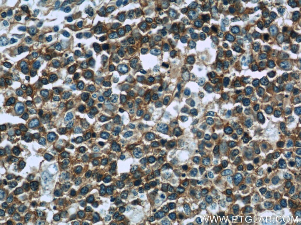 IHC staining of human tonsillitis using 24289-1-AP