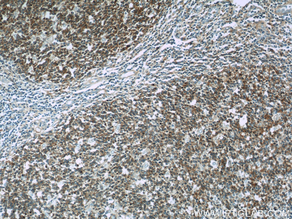 Immunohistochemistry (IHC) staining of human tonsillitis tissue using RFTN1 Polyclonal antibody (24289-1-AP)