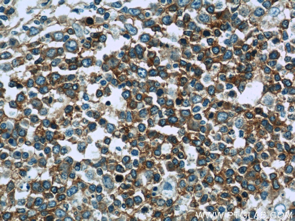 Immunohistochemistry (IHC) staining of human tonsillitis tissue using RFTN1 Polyclonal antibody (24289-1-AP)