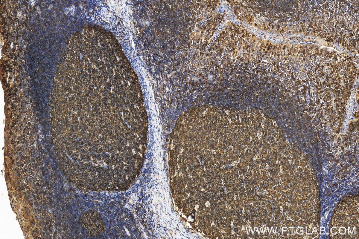 Immunohistochemistry (IHC) staining of human tonsillitis tissue using RFTN1 Polyclonal antibody (24289-1-AP)