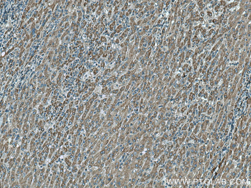 Immunohistochemistry (IHC) staining of human liver cancer tissue using RFTN2 Polyclonal antibody (17854-1-AP)