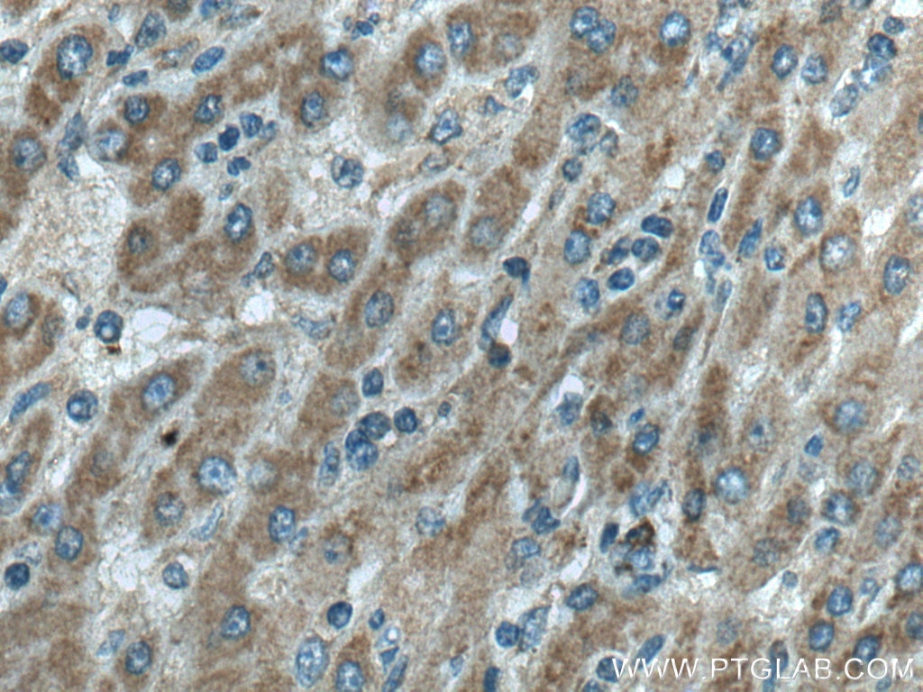 Immunohistochemistry (IHC) staining of human liver cancer tissue using RFTN2 Polyclonal antibody (17854-1-AP)