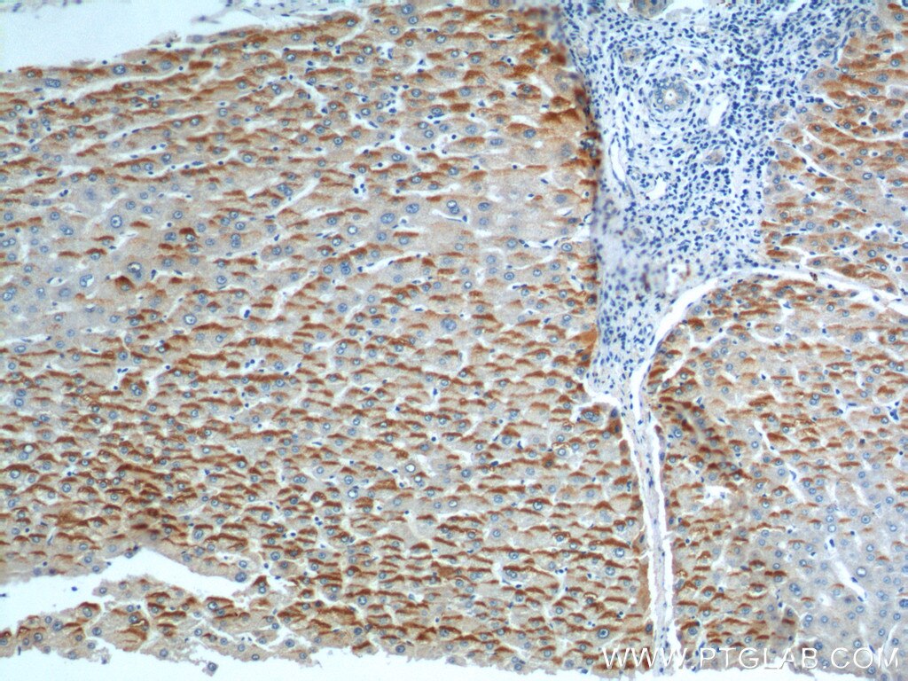 Immunohistochemistry (IHC) staining of human liver cancer tissue using RFTN2 Polyclonal antibody (17854-1-AP)