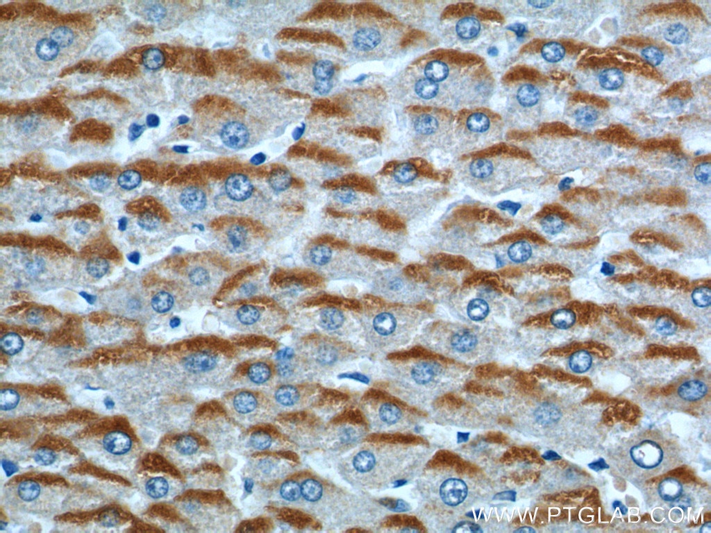 Immunohistochemistry (IHC) staining of human liver cancer tissue using RFTN2 Polyclonal antibody (17854-1-AP)
