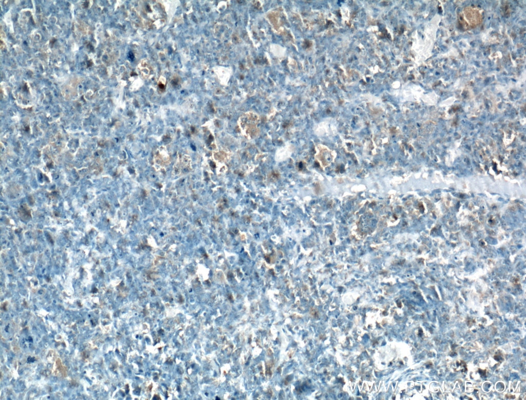 Immunohistochemistry (IHC) staining of human osteosarcoma tissue using COP1 Polyclonal antibody (13542-1-AP)