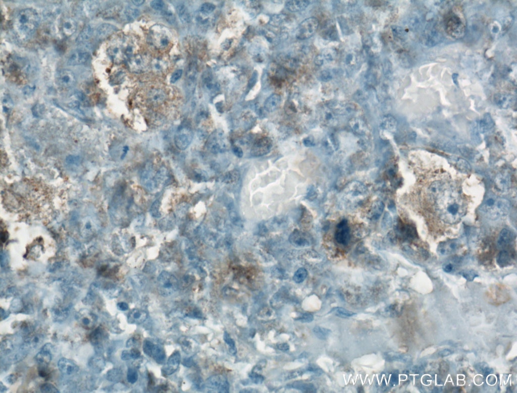 Immunohistochemistry (IHC) staining of human osteosarcoma tissue using COP1 Polyclonal antibody (13542-1-AP)