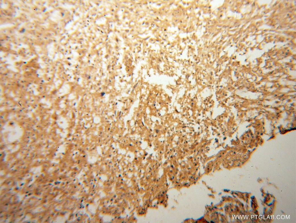 Immunohistochemistry (IHC) staining of human osteosarcoma tissue using COP1 Polyclonal antibody (13542-1-AP)