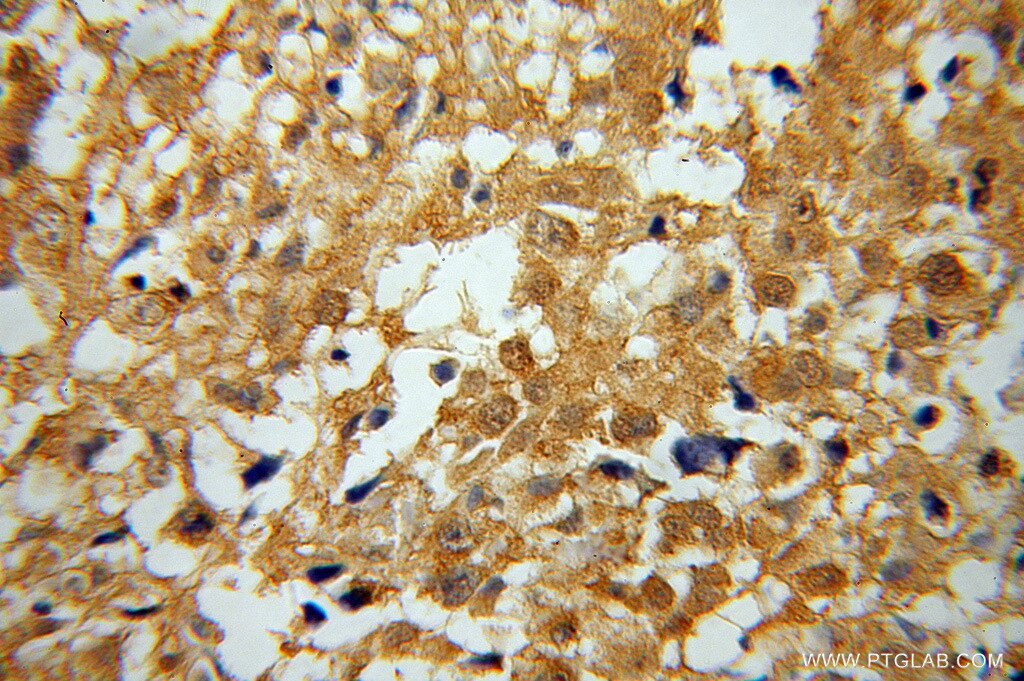 Immunohistochemistry (IHC) staining of human osteosarcoma tissue using COP1 Polyclonal antibody (13542-1-AP)