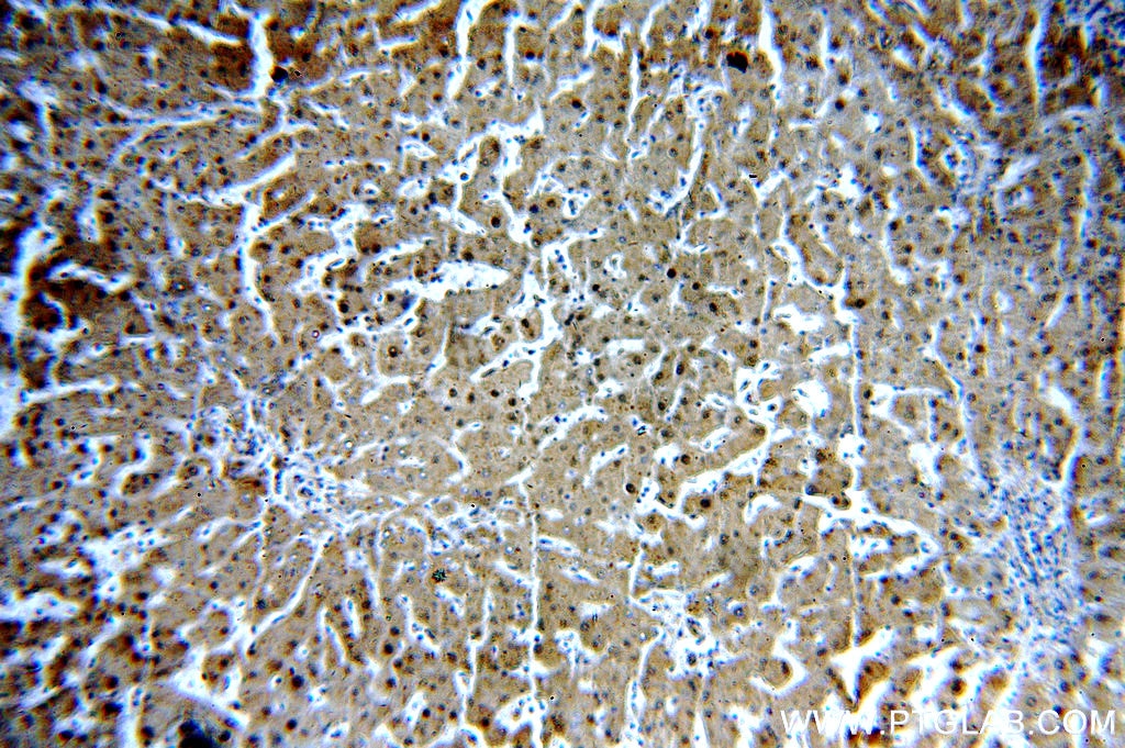 Immunohistochemistry (IHC) staining of human hepatocirrhosis tissue using RGN/SMP30 Polyclonal antibody (17947-1-AP)