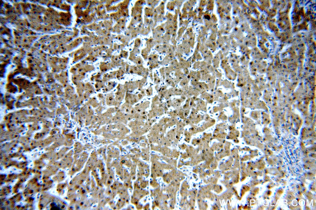 Immunohistochemistry (IHC) staining of human hepatocirrhosis tissue using RGN/SMP30 Polyclonal antibody (17947-1-AP)