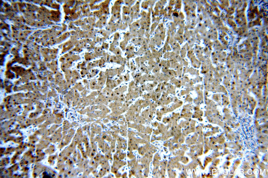 IHC staining of human hepatocirrhosis using 17947-1-AP