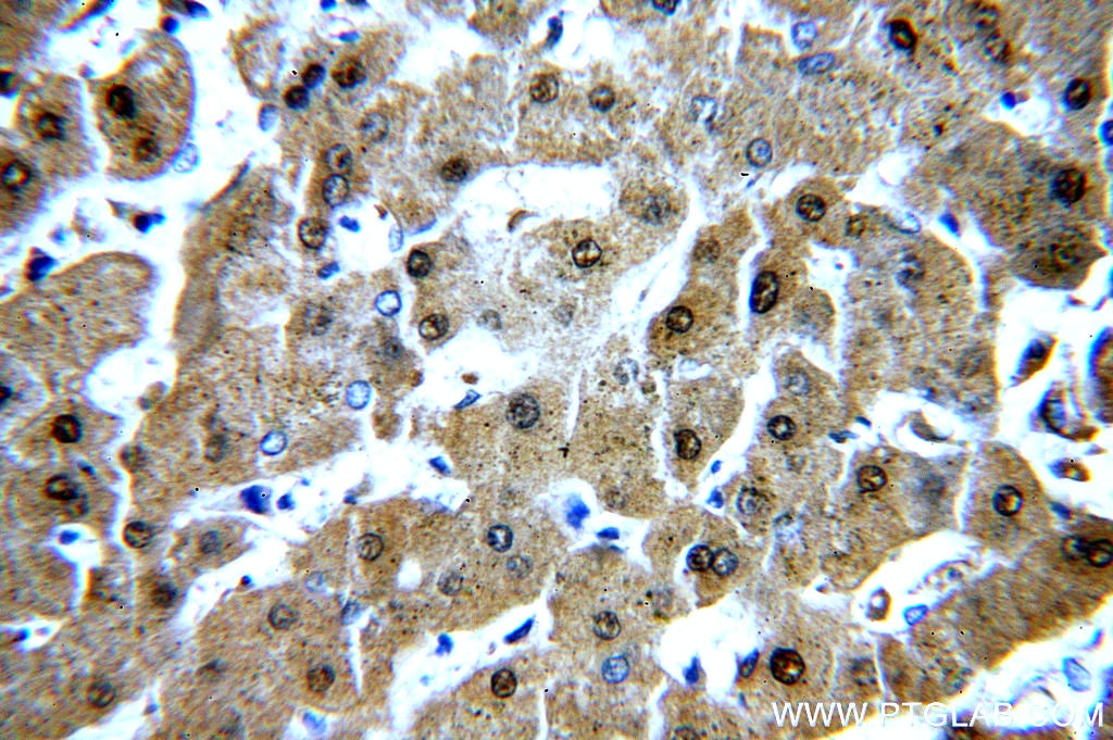 Immunohistochemistry (IHC) staining of human hepatocirrhosis tissue using RGN/SMP30 Polyclonal antibody (17947-1-AP)