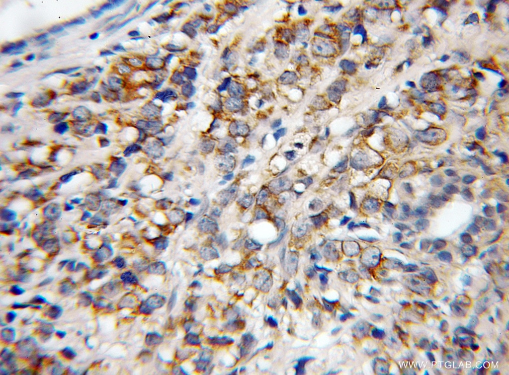 Immunohistochemistry (IHC) staining of human prostate cancer tissue using RGR Polyclonal antibody (11904-1-AP)