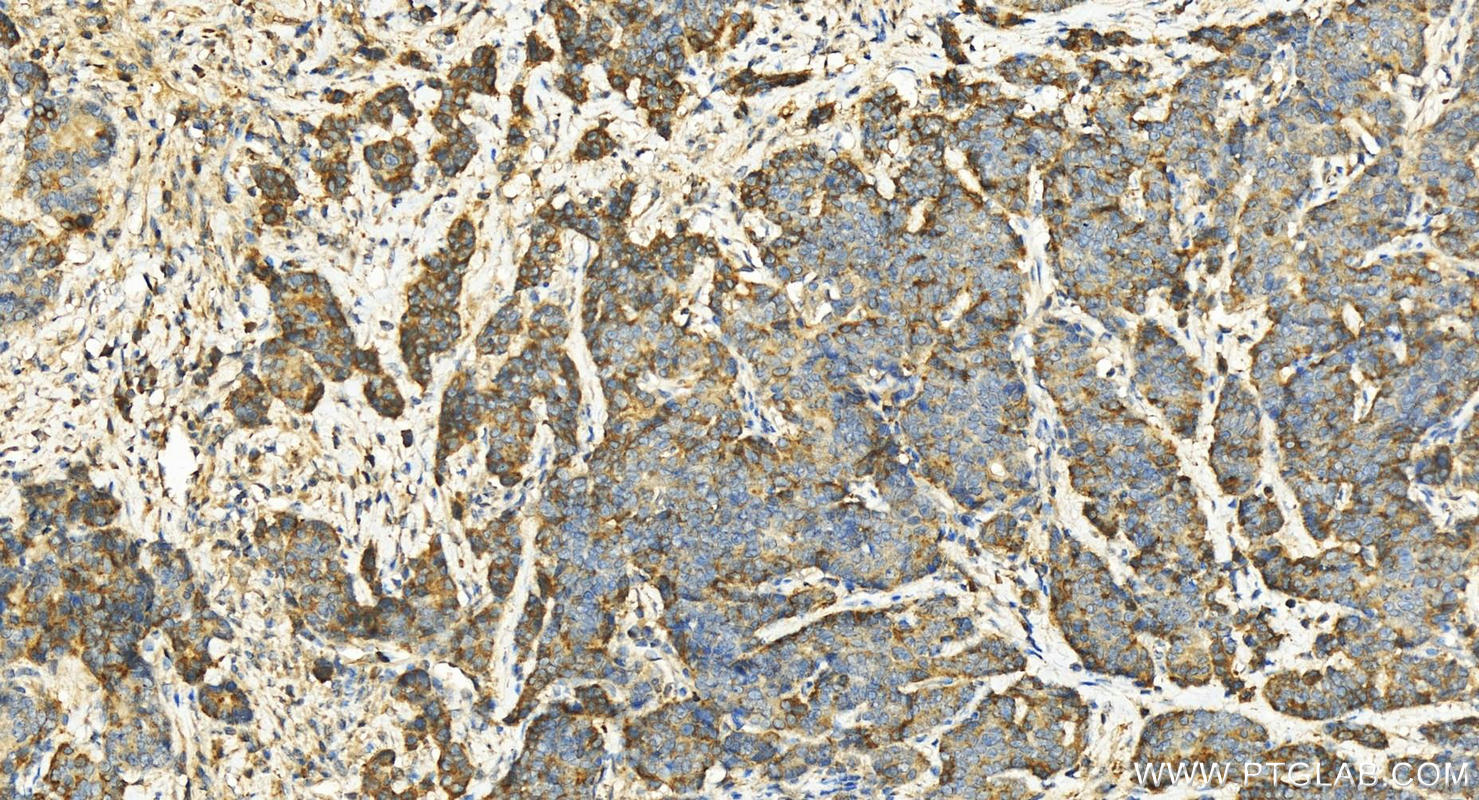 Immunohistochemistry (IHC) staining of human stomach cancer tissue using RGS1 Polyclonal antibody (12547-1-AP)