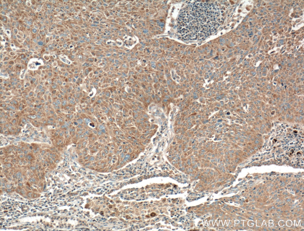 Immunohistochemistry (IHC) staining of human lung cancer tissue using RGS11 Polyclonal antibody (26132-1-AP)