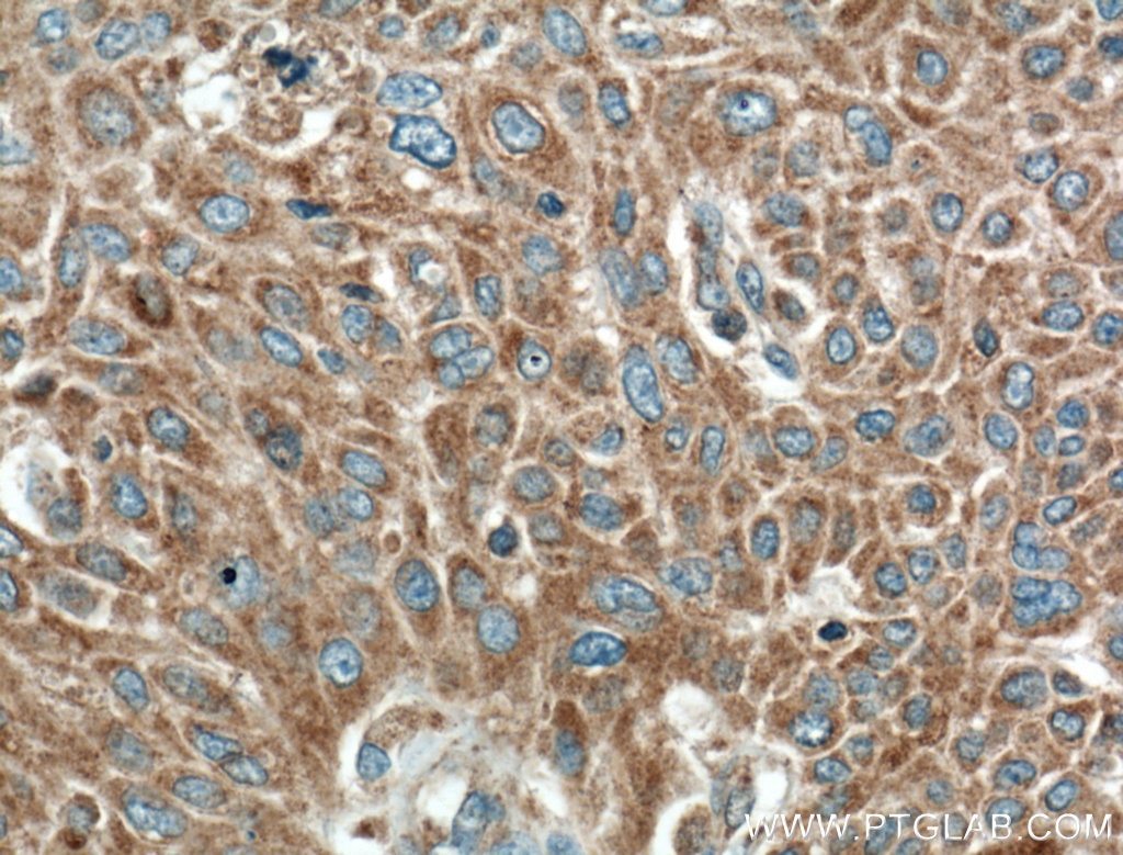 Immunohistochemistry (IHC) staining of human lung cancer tissue using RGS11 Polyclonal antibody (26132-1-AP)