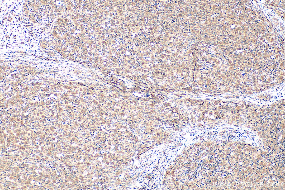 Immunohistochemistry (IHC) staining of human lymphoma tissue using RGS13 Polyclonal antibody (12396-1-AP)