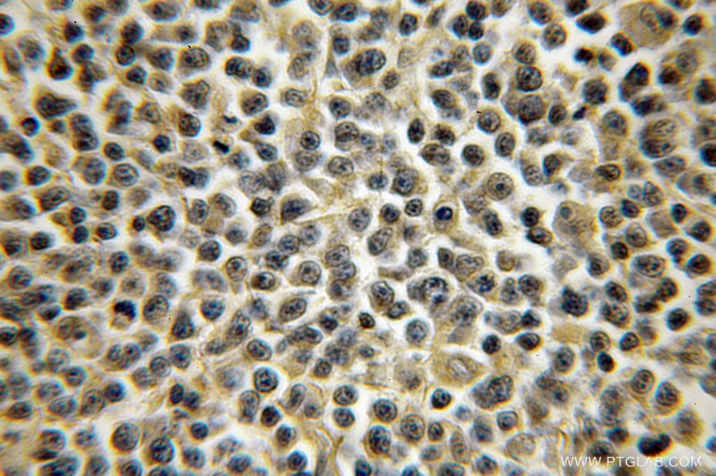 Immunohistochemistry (IHC) staining of human lymphoma tissue using RGS13 Polyclonal antibody (12396-1-AP)