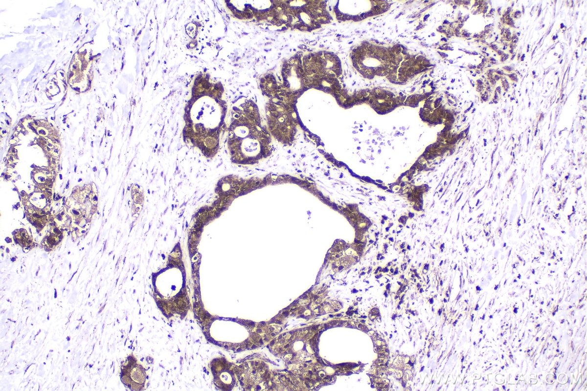 Immunohistochemistry (IHC) staining of human pancreas cancer tissue using RGS2 Polyclonal antibody (10678-1-AP)