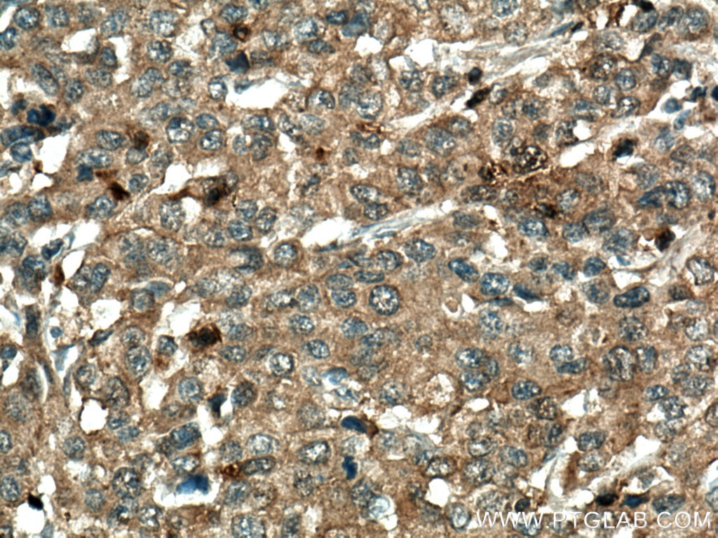 Immunohistochemistry (IHC) staining of human stomach cancer tissue using RGS5 Polyclonal antibody (11590-1-AP)