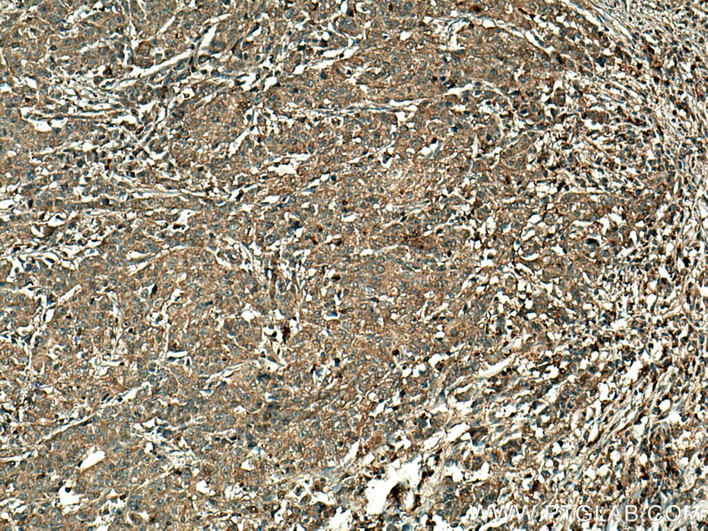 Immunohistochemistry (IHC) staining of human stomach cancer tissue using RGS5 Polyclonal antibody (11590-1-AP)