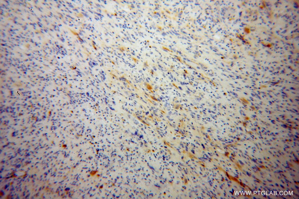 Immunohistochemistry (IHC) staining of human gliomas tissue using RGS7 Polyclonal antibody (14056-1-AP)