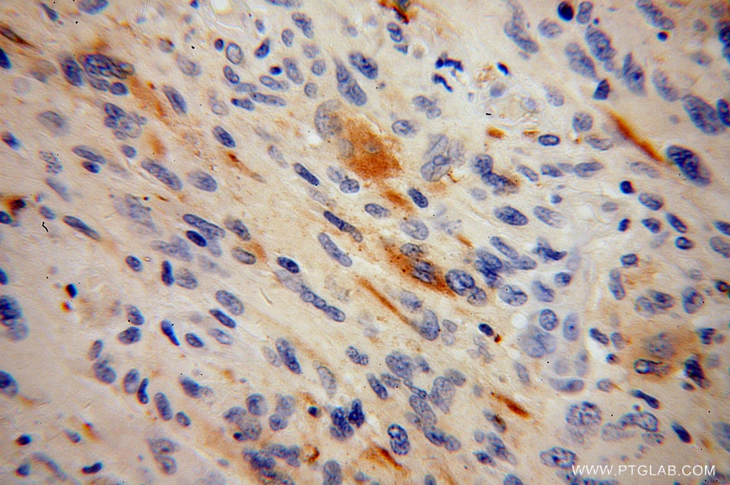 Immunohistochemistry (IHC) staining of human gliomas tissue using RGS7 Polyclonal antibody (14056-1-AP)