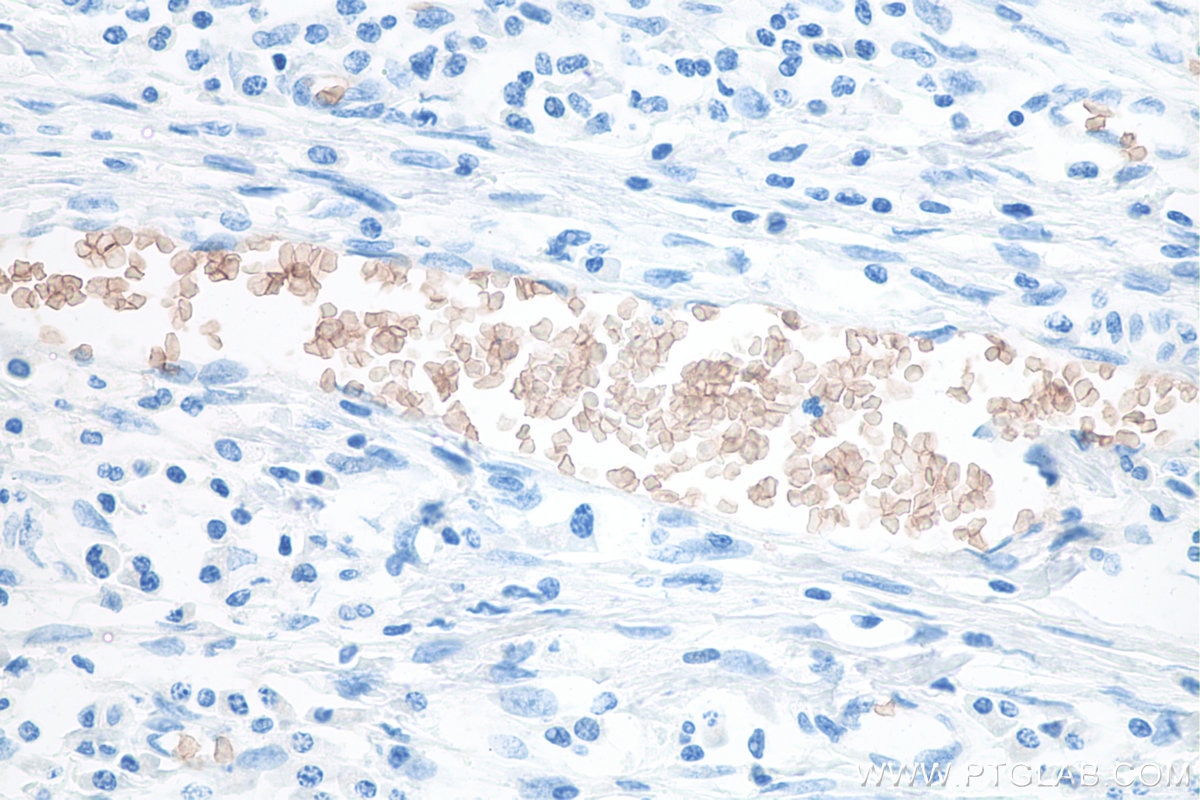 IHC staining of human colon cancer using 67714-1-Ig Immunohistochemistry (IHC) staining of human colon cancer tissue using RHAG Monoclonal antibody (67714-1-Ig)