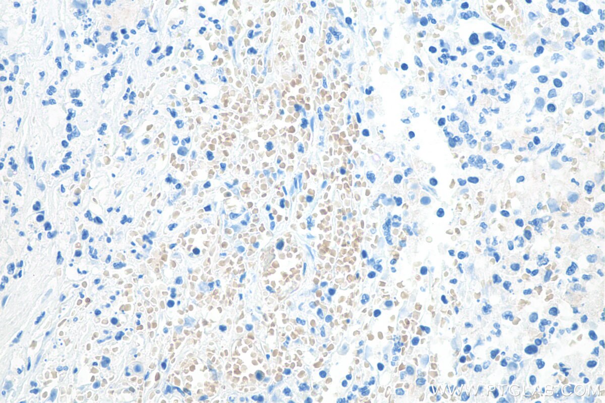 IHC staining of human stomach cancer using 67714-1-Ig Immunohistochemistry (IHC) staining of human stomach cancer tissue using RHAG Monoclonal antibody (67714-1-Ig)