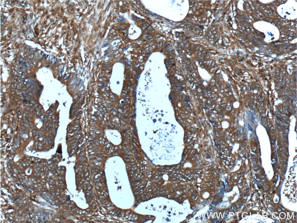 Immunohistochemistry (IHC) staining of human colon cancer tissue using RHBDF2 Polyclonal antibody (23181-1-AP)