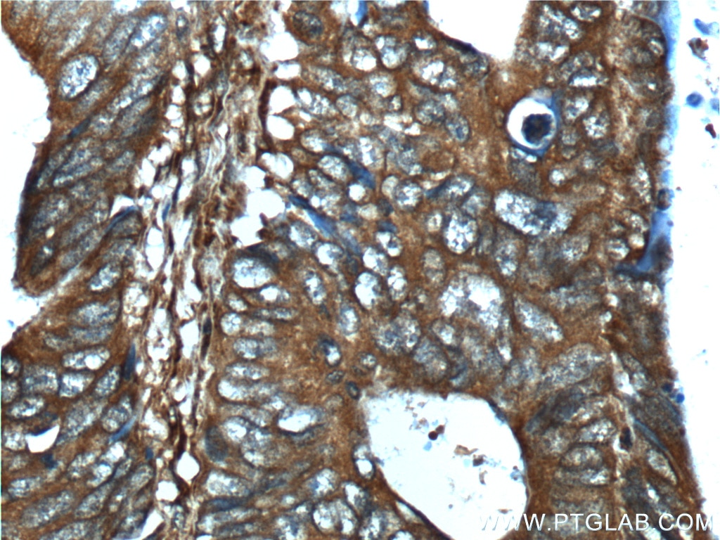 Immunohistochemistry (IHC) staining of human colon cancer tissue using RHBDF2 Polyclonal antibody (23181-1-AP)