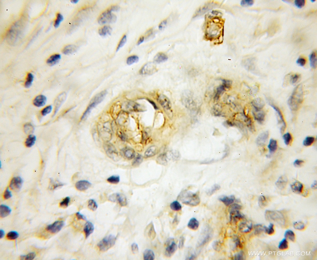Immunohistochemistry (IHC) staining of human pancreas cancer tissue using RHCG Polyclonal antibody (11949-1-AP)
