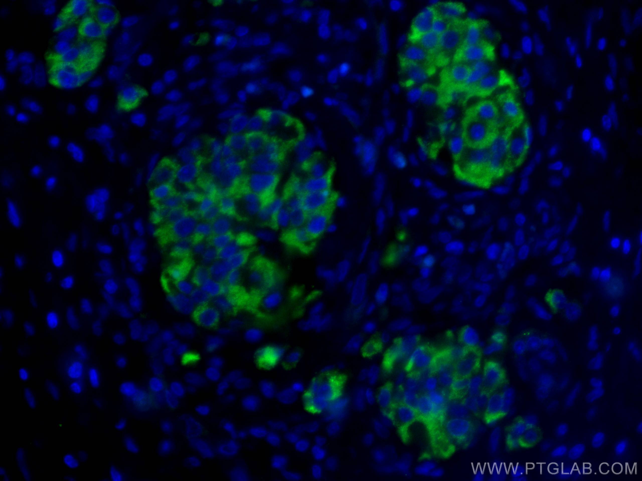 Immunofluorescence (IF) / fluorescent staining of human pancreas cancer tissue using RHEB Polyclonal antibody (15924-1-AP)