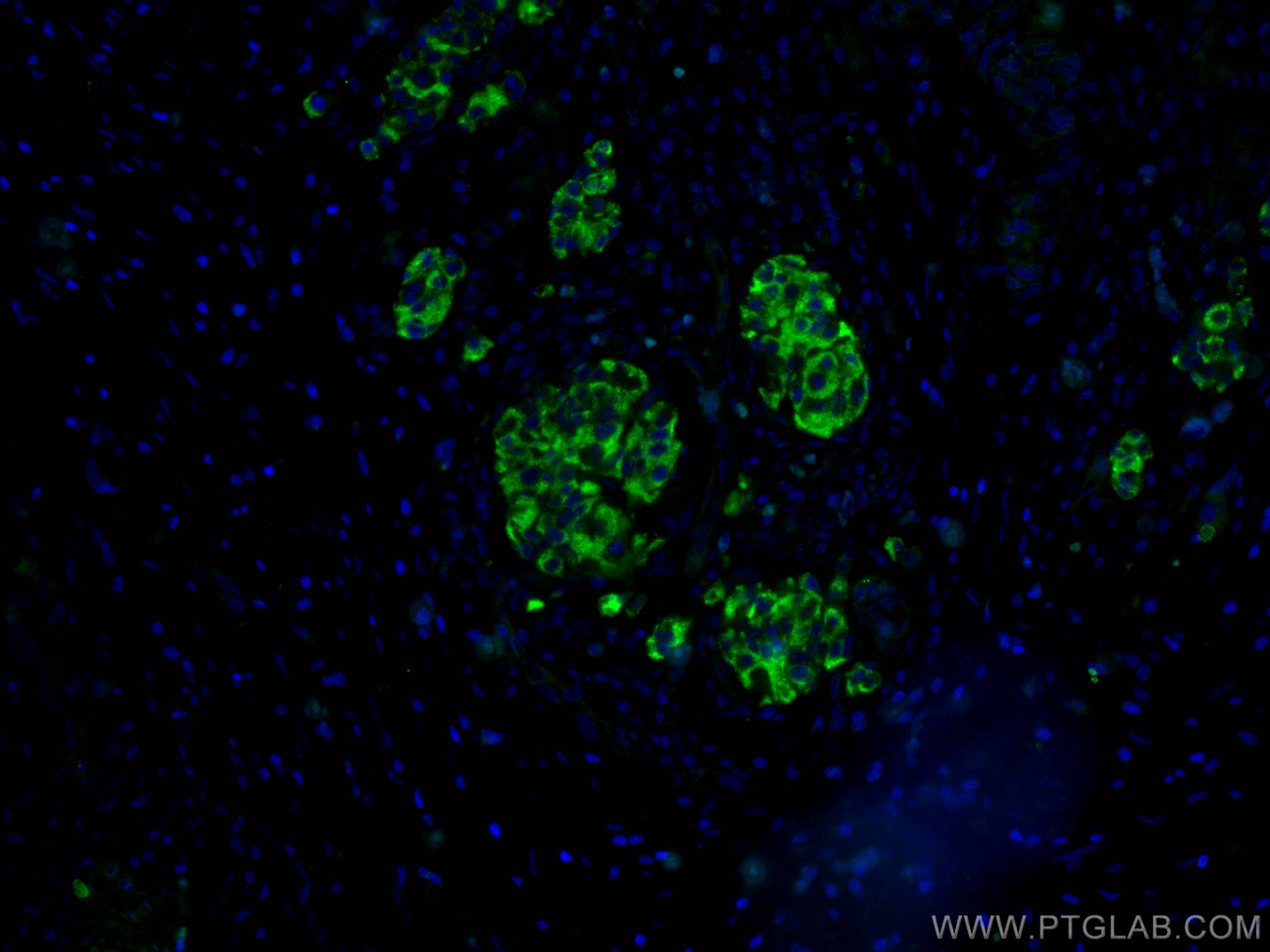 Immunofluorescence (IF) / fluorescent staining of human pancreas cancer tissue using RHEB Polyclonal antibody (15924-1-AP)