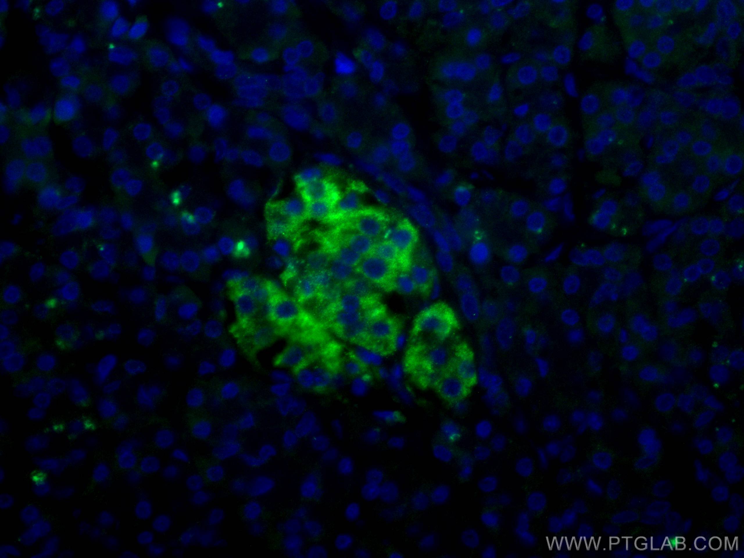 Immunofluorescence (IF) / fluorescent staining of human pancreas cancer tissue using RHEB Monoclonal antibody (66714-1-Ig)
