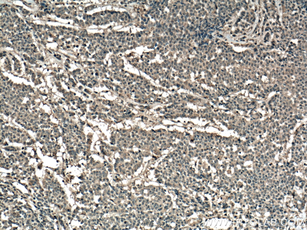 IHC staining of human colon cancer using 66733-1-Ig