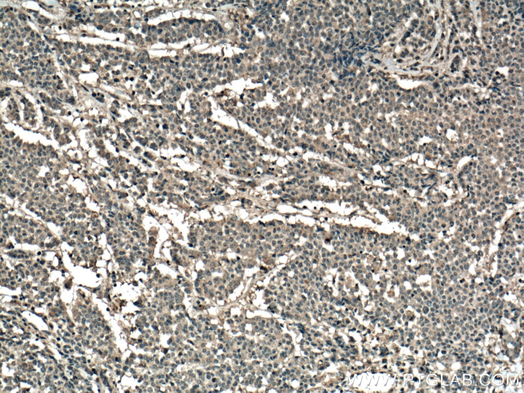 Immunohistochemistry (IHC) staining of human colon cancer tissue using RHOA Monoclonal antibody (66733-1-Ig)