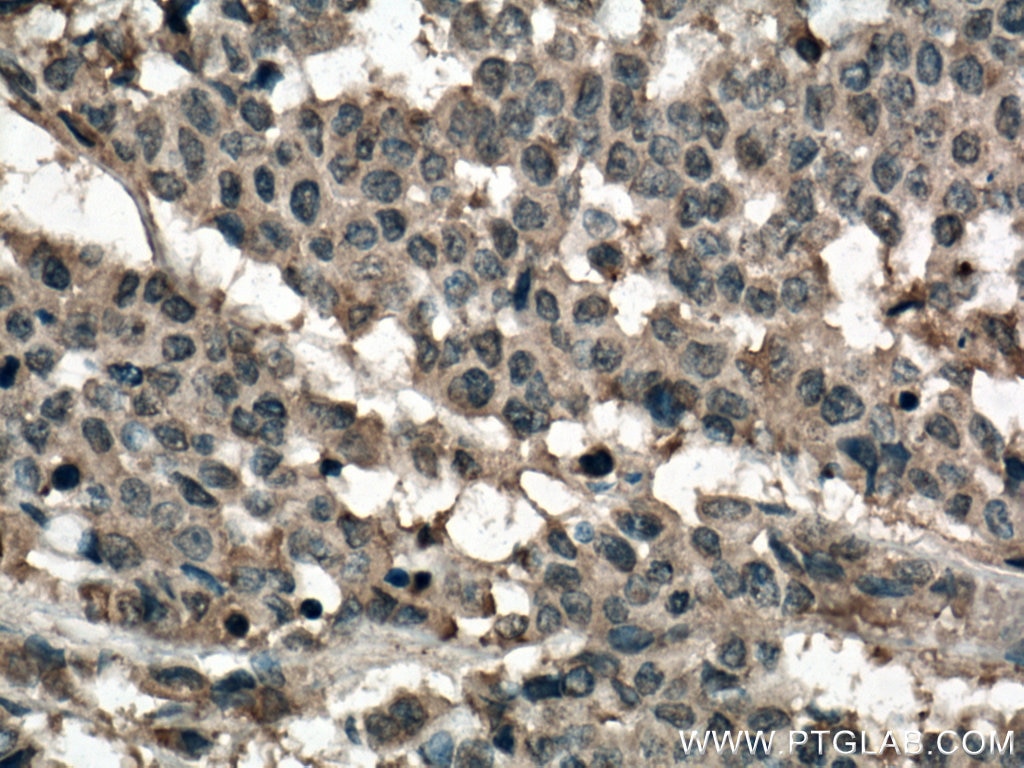 Immunohistochemistry (IHC) staining of human colon cancer tissue using RHOA Monoclonal antibody (66733-1-Ig)